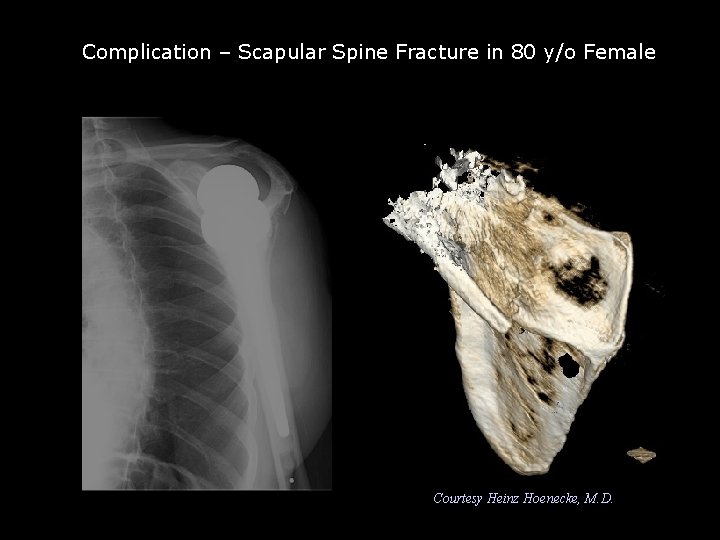 Complication – Scapular Spine Fracture in 80 y/o Female Scapular spine fracture Courtesy Heinz