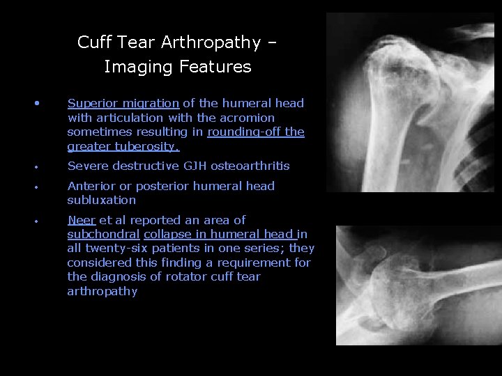 Cuff Tear Arthropathy – Imaging Features -- • Superior migration of the humeral head