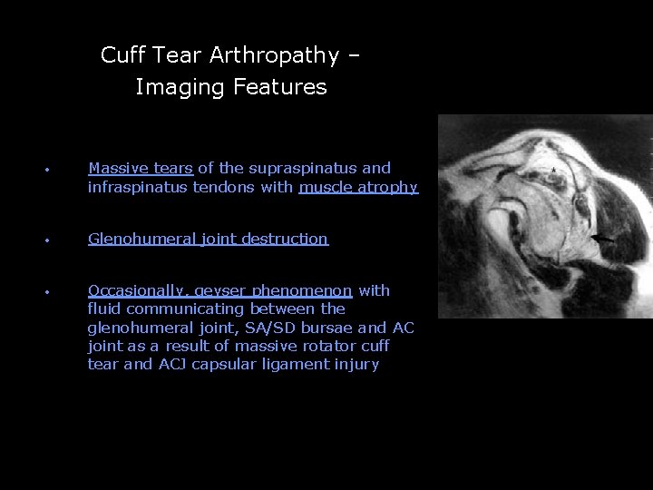 Cuff Tear Arthropathy – Imaging Features -- • Massive tears of the supraspinatus and