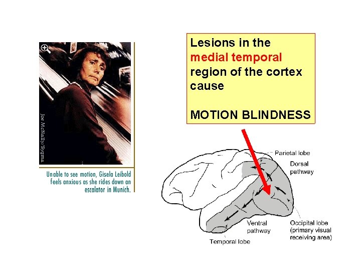 Lesions in the medial temporal region of the cortex cause MOTION BLINDNESS 