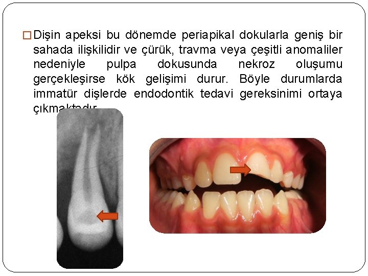 � Dişin apeksi bu dönemde periapikal dokularla geniş bir sahada ilişkilidir ve çürük, travma