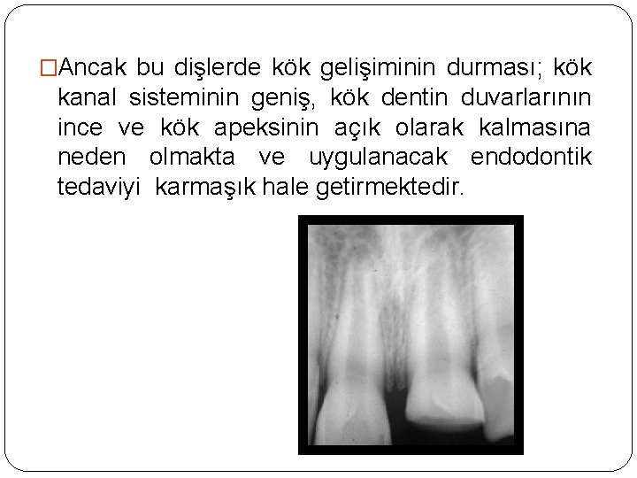 �Ancak bu dişlerde kök gelişiminin durması; kök kanal sisteminin geniş, kök dentin duvarlarının ince