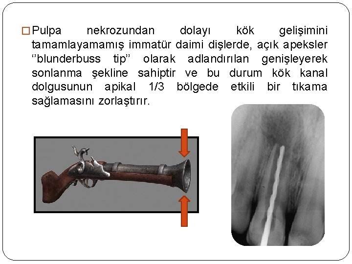 � Pulpa nekrozundan dolayı kök gelişimini tamamlayamamış immatür daimi dişlerde, açık apeksler ‘’blunderbuss tip’’