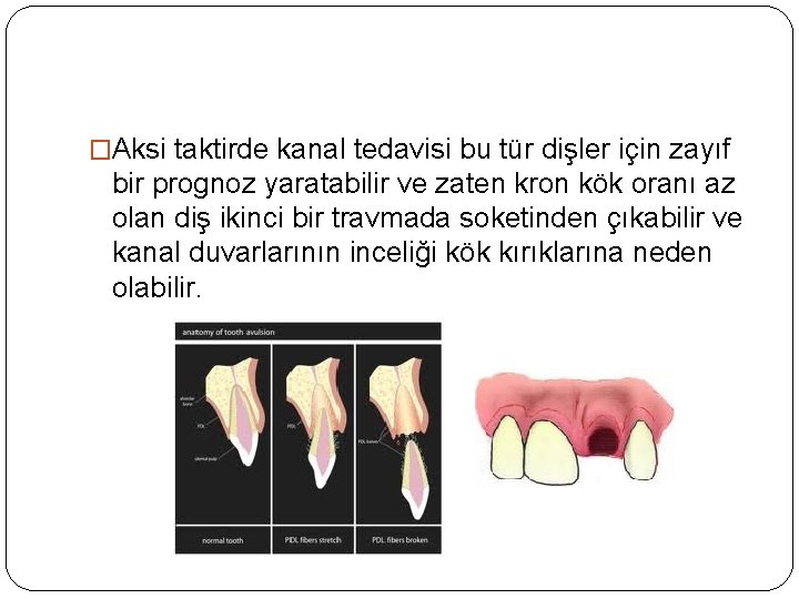�Aksi taktirde kanal tedavisi bu tür dişler için zayıf bir prognoz yaratabilir ve zaten
