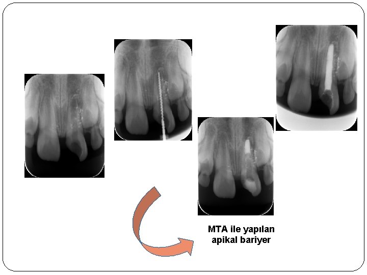 MTA ile yapılan apikal bariyer 