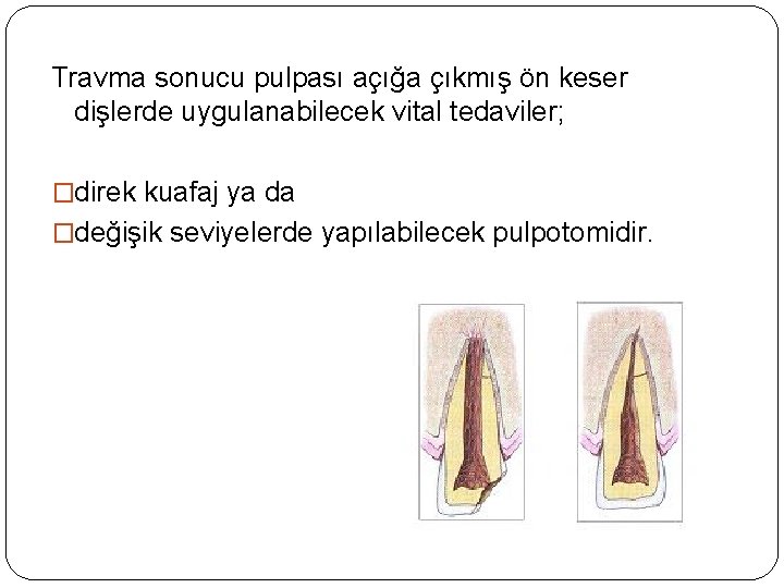 Travma sonucu pulpası açığa çıkmış ön keser dişlerde uygulanabilecek vital tedaviler; �direk kuafaj ya