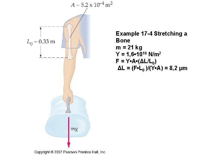 Example 17 -4 Stretching a Bone m = 21 kg Y = 1, 6