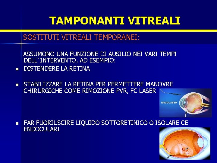 TAMPONANTI VITREALI SOSTITUTI VITREALI TEMPORANEI: n ASSUMONO UNA FUNZIONE DI AUSILIO NEI VARI TEMPI