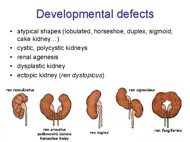 Developmental defects • atypical shapes (lobulated, horseshoe, duplex, sigmoid, cake kidney…) • cystic, polycystic Developmental defects • atypical shapes (lobulated, horseshoe, duplex, sigmoid, cake kidney…) • cystic, polycystic