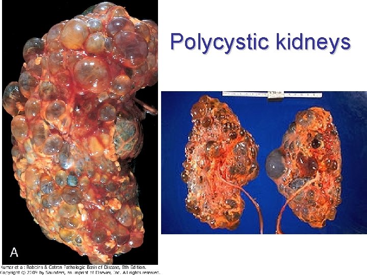 Polycystic kidneys Polycystic kidneys