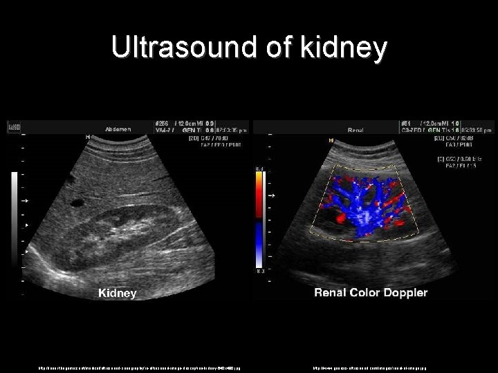 Ultrasound of kidney http: //lunar. thegamez. net/medical/ultrasound-sonography/ru-ultrasound-image-description-kidney-640 x 480. jpg http: //www. genesis-ultrasound. com/images/renal-ul-image. Ultrasound of kidney http: //lunar. thegamez. net/medical/ultrasound-sonography/ru-ultrasound-image-description-kidney-640 x 480. jpg http: //www. genesis-ultrasound. com/images/renal-ul-image.