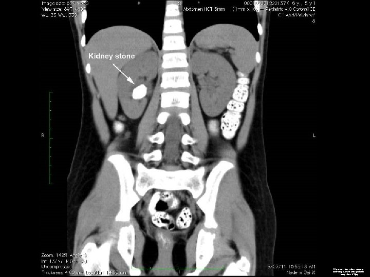 http: //www. kidneystoners. org/wpcontent/uploads/2012/02/pediatrickidney-stone-CT. jpg http: //www. kidneystoners. org/wpcontent/uploads/2012/02/pediatrickidney-stone-CT. jpg