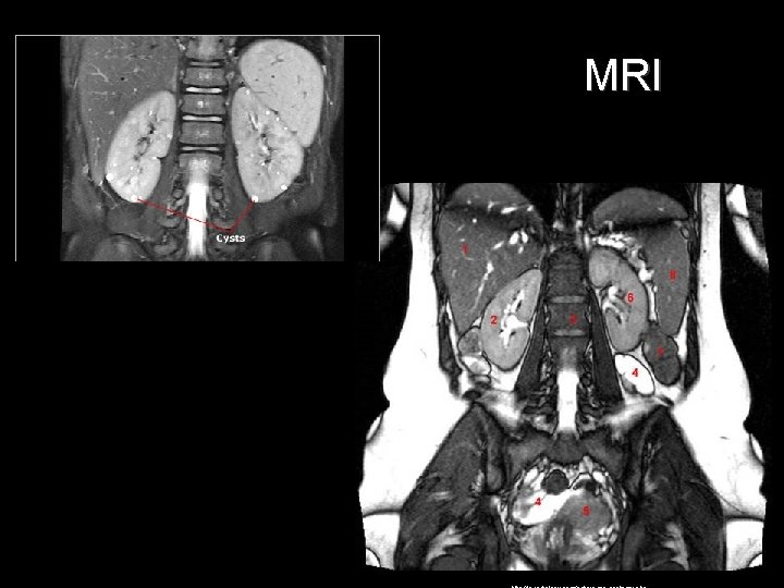 MRI MRI