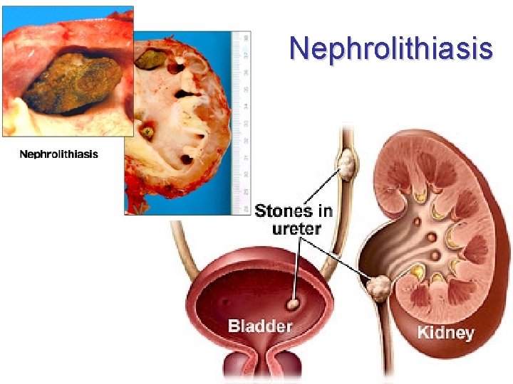 Nephrolithiasis Nephrolithiasis