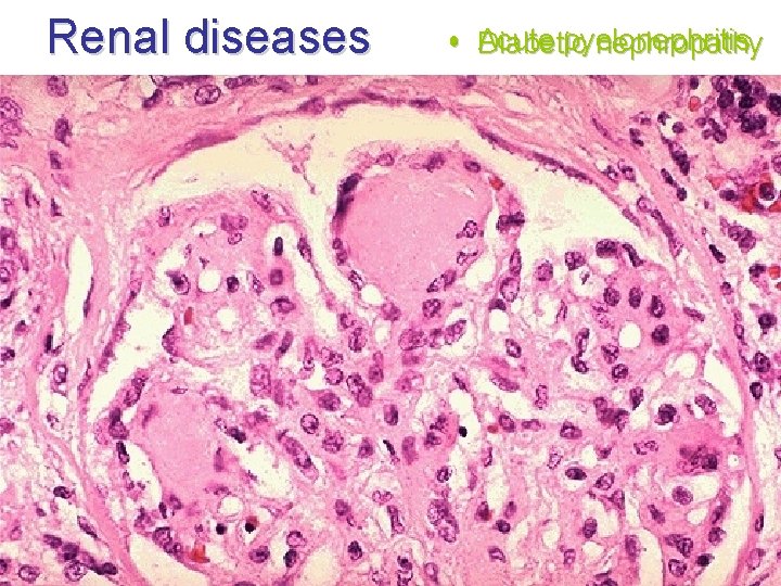 Renal diseases • A cute pyelone phritihy s Diabetic nephropat Renal diseases • A cute pyelone phritihy s Diabetic nephropat
