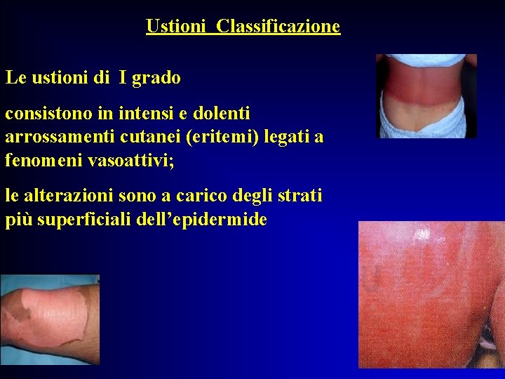 Ustioni Classificazione Le ustioni di I grado consistono in intensi e dolenti arrossamenti cutanei