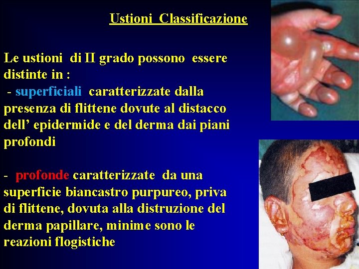 Ustioni Classificazione Le ustioni di II grado possono essere distinte in : - superficiali