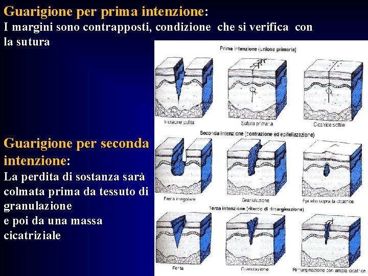 Guarigione per prima intenzione: I margini sono contrapposti, condizione che si verifica con la