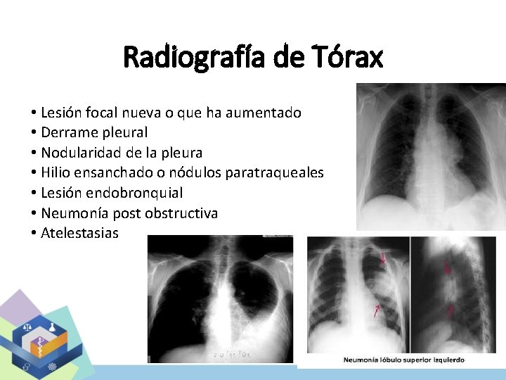 Radiografía de Tórax • Lesión focal nueva o que ha aumentado • Derrame pleural