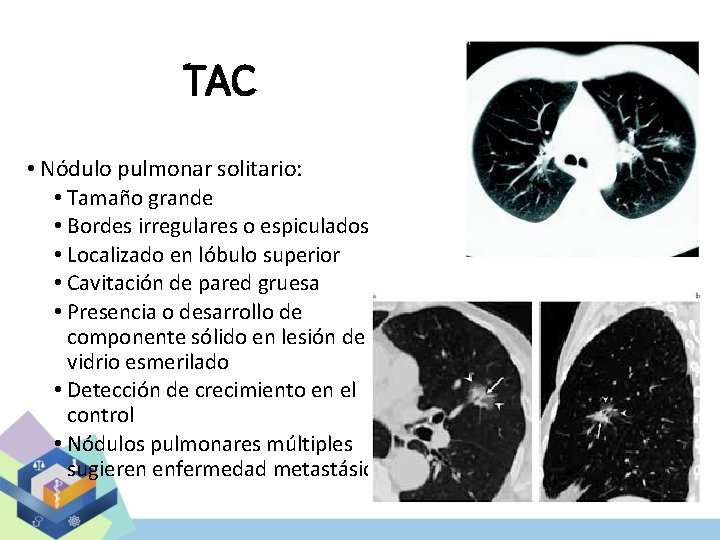 TAC • Nódulo pulmonar solitario: • Tamaño grande • Bordes irregulares o espiculados •