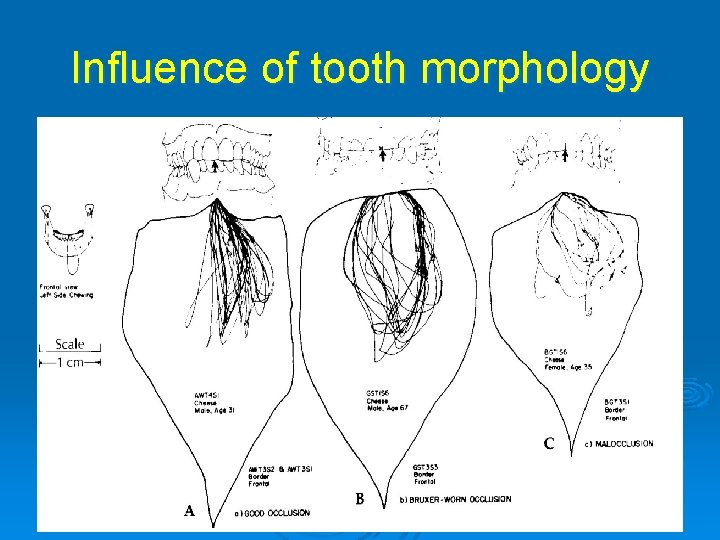 Influence of tooth morphology 