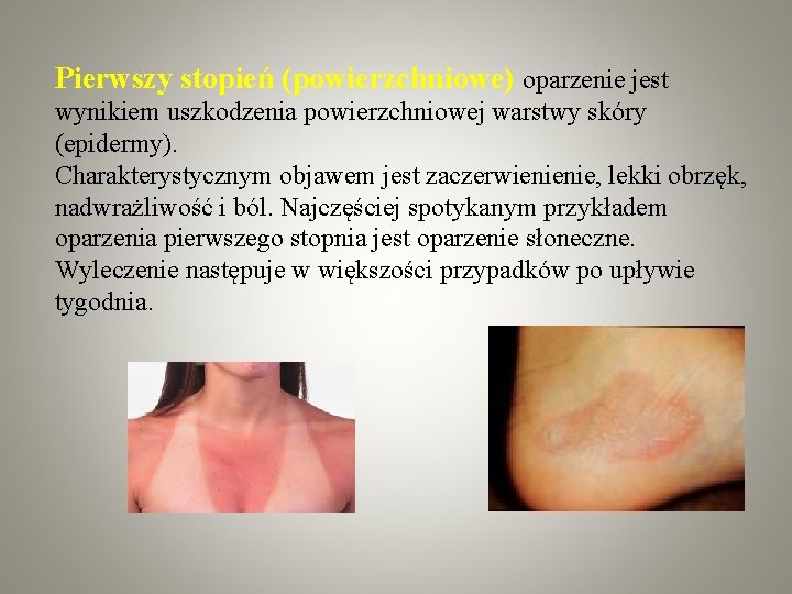 Pierwszy stopień (powierzchniowe) oparzenie jest wynikiem uszkodzenia powierzchniowej warstwy skóry (epidermy). Charakterystycznym objawem jest