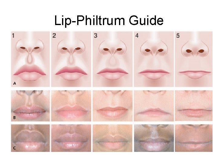 Lip-Philtrum Guide 