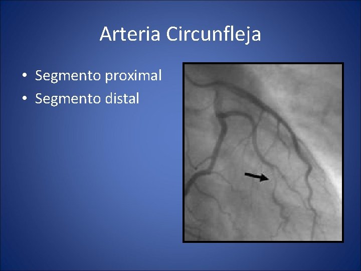 Arteria Circunfleja • Segmento proximal • Segmento distal 