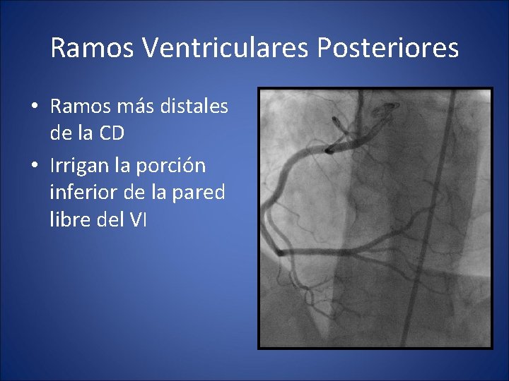 Ramos Ventriculares Posteriores • Ramos más distales de la CD • Irrigan la porción