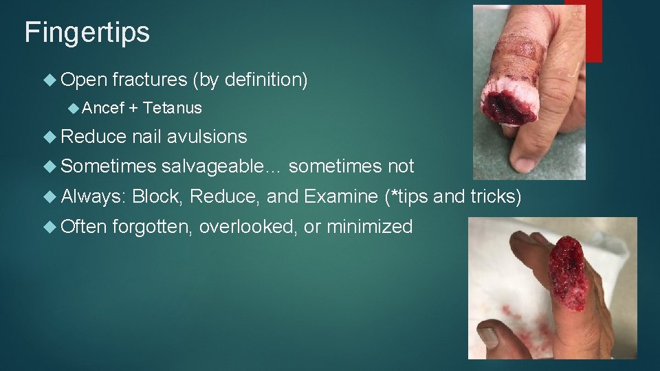 Fingertips Open fractures (by definition) Ancef Reduce + Tetanus nail avulsions Sometimes Always: Often