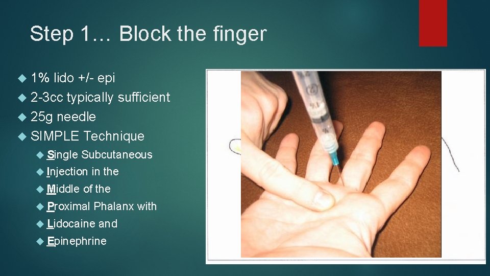 Step 1… Block the finger 1% lido +/- epi 2 -3 cc typically sufficient