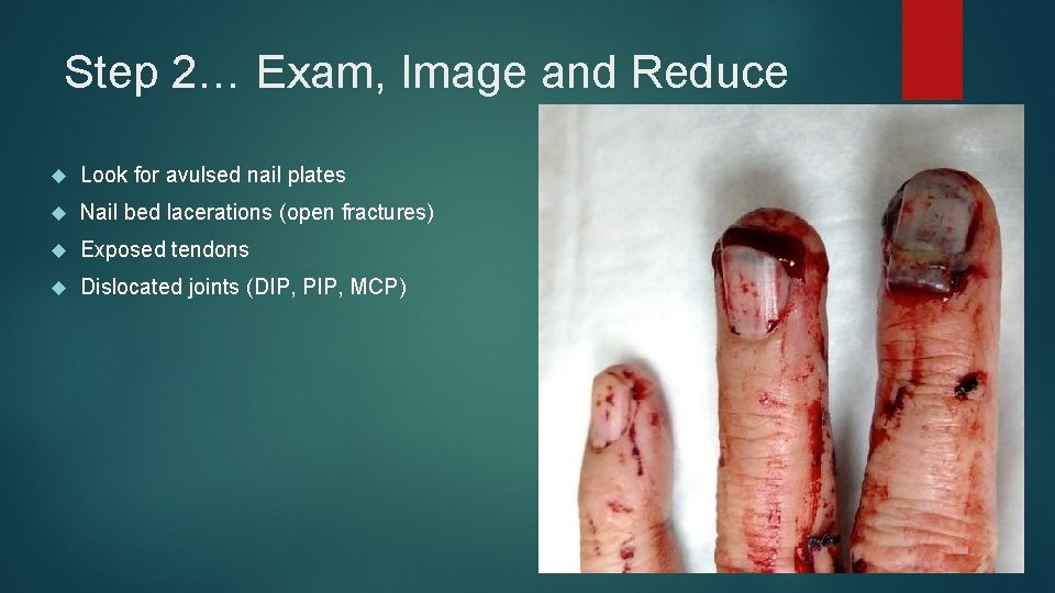 Step 2… Exam, Image and Reduce Look for avulsed nail plates Nail bed lacerations