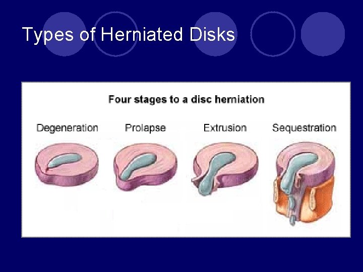 Types of Herniated Disks 