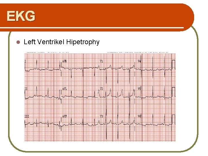 EKG l Left Ventrikel Hipetrophy 