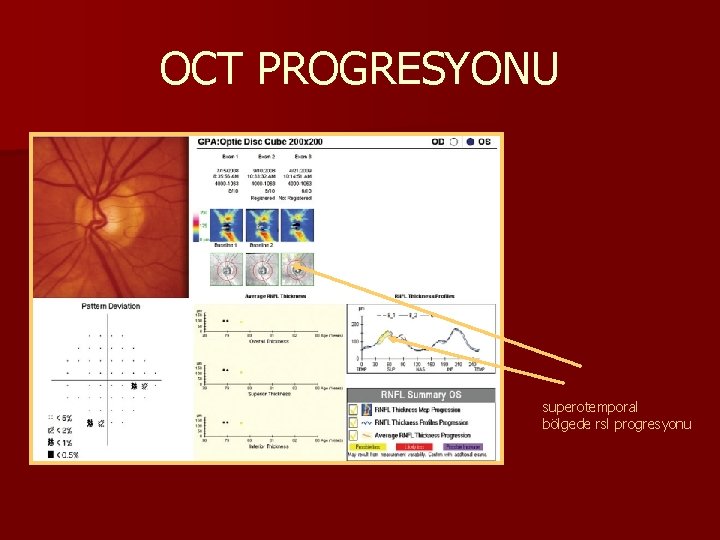 OCT PROGRESYONU superotemporal bölgede rsl progresyonu 
