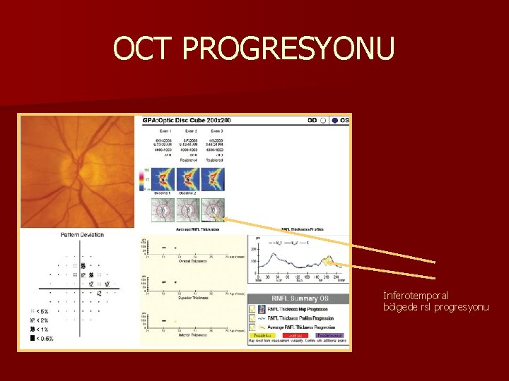 OCT PROGRESYONU İnferotemporal bölgede rsl progresyonu 