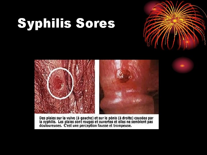 Syphilis Sores Syphilis Sores
