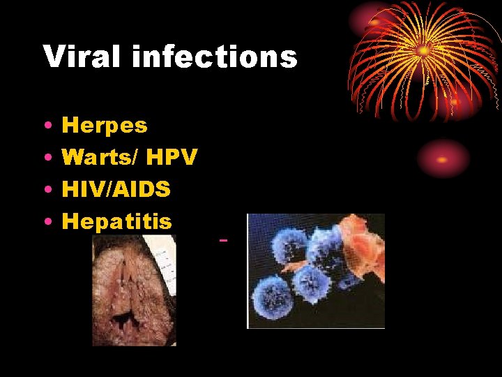 Viral infections • • Herpes Warts/ HPV HIV/AIDS Hepatitis Viral infections • • Herpes Warts/ HPV HIV/AIDS Hepatitis