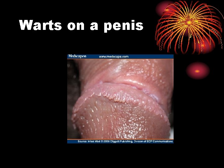 Warts on a penis Warts on a penis