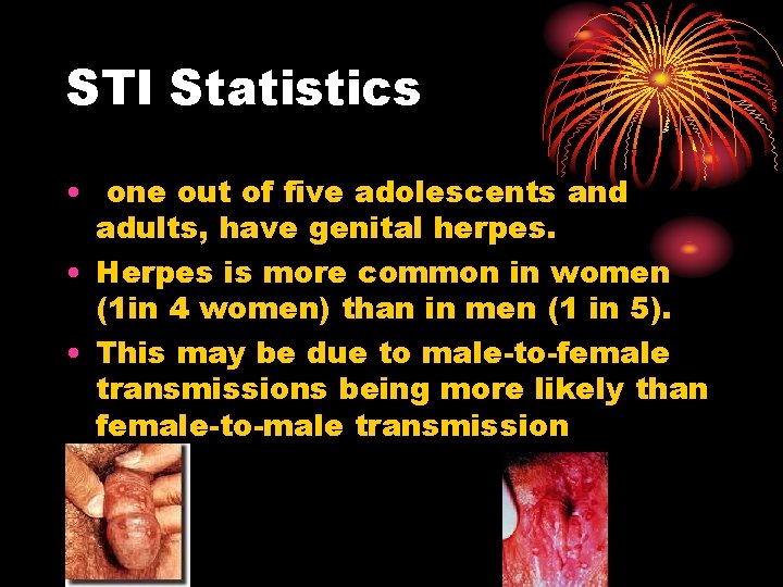 STI Statistics • one out of five adolescents and adults, have genital herpes. • STI Statistics • one out of five adolescents and adults, have genital herpes. •
