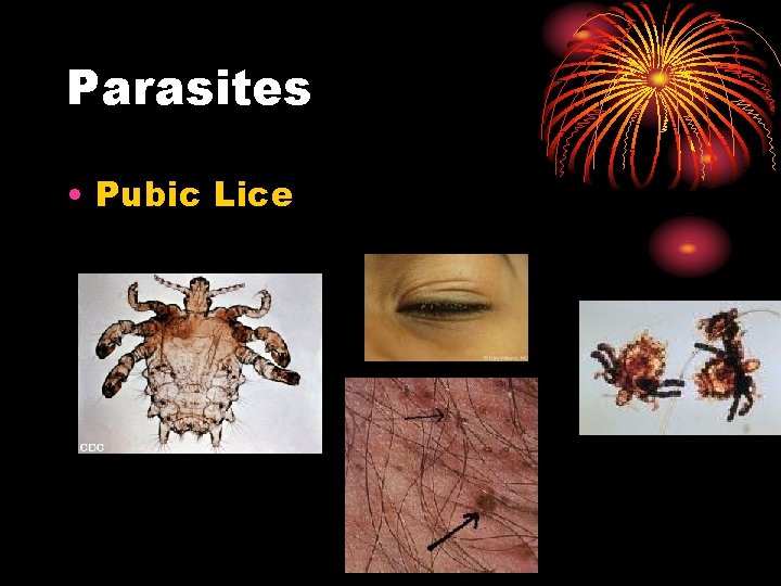 Parasites • Pubic Lice Parasites • Pubic Lice