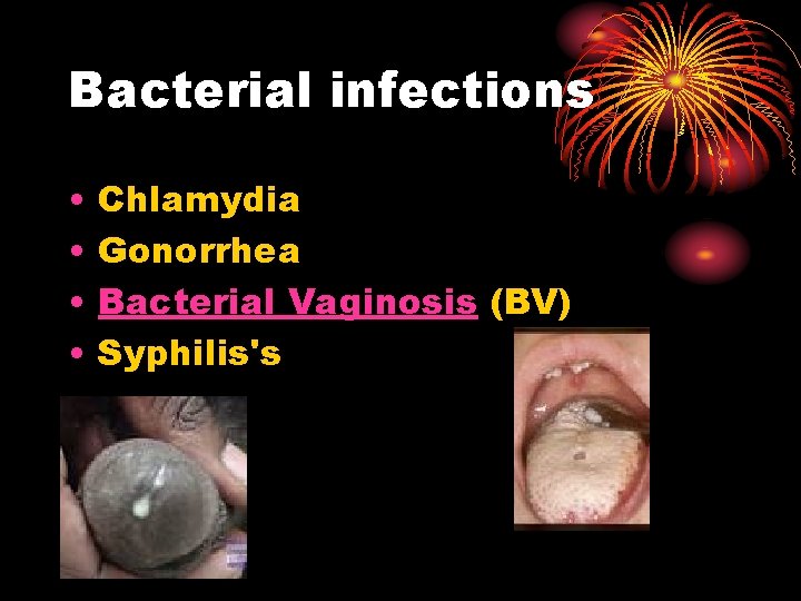 Bacterial infections • • Chlamydia Gonorrhea Bacterial Vaginosis (BV) Syphilis's Bacterial infections • • Chlamydia Gonorrhea Bacterial Vaginosis (BV) Syphilis's