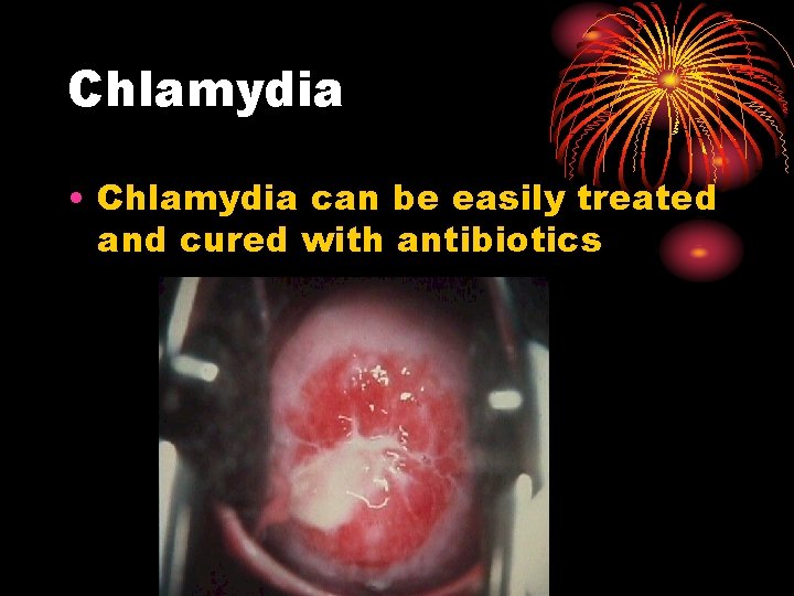 Chlamydia • Chlamydia can be easily treated and cured with antibiotics Chlamydia • Chlamydia can be easily treated and cured with antibiotics