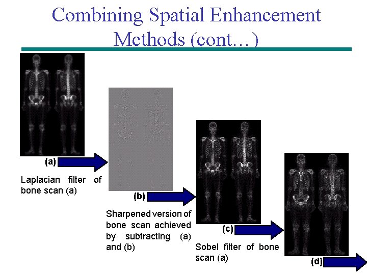 Combining Spatial Enhancement Methods (cont…) (a) Laplacian filter of bone scan (a) (b) Sharpened Combining Spatial Enhancement Methods (cont…) (a) Laplacian filter of bone scan (a) (b) Sharpened