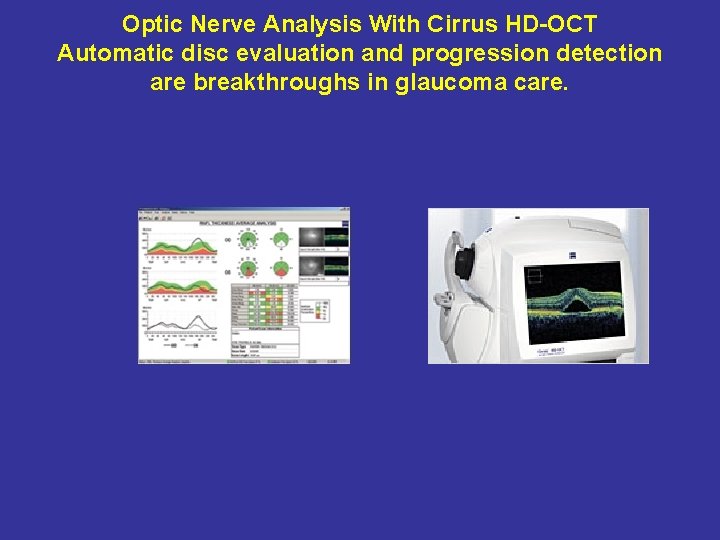 Optic Nerve Analysis With Cirrus HD-OCT Automatic disc evaluation and progression detection are breakthroughs