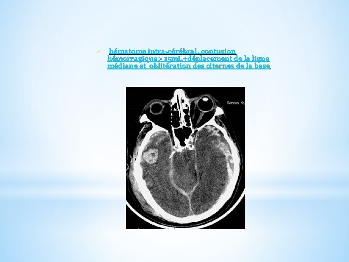 ü hématome intra-cérébral, contusion hémorragique> 15 m. L+déplacement de la ligne médiane et oblitération
