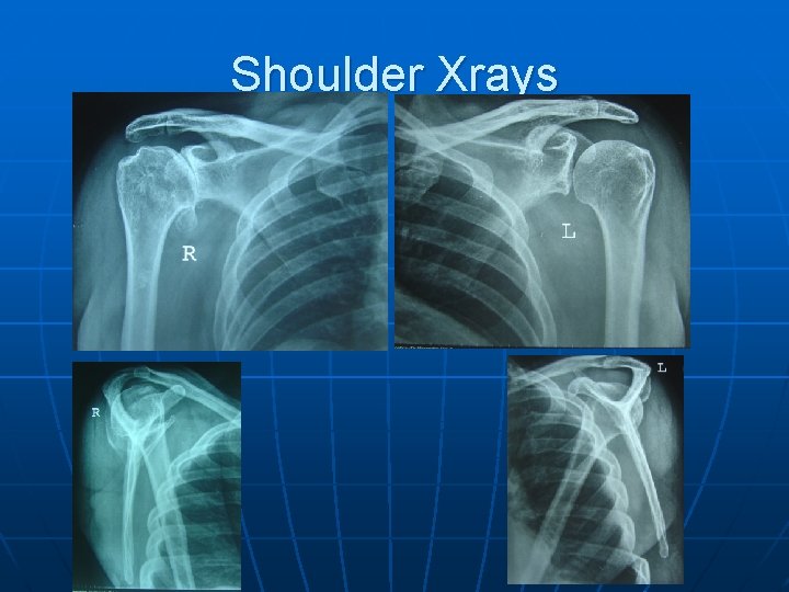 Shoulder Xrays 