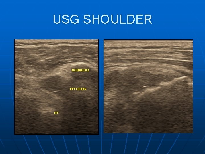 USG SHOULDER 