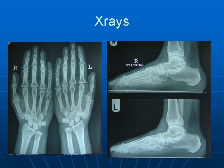 Xrays 