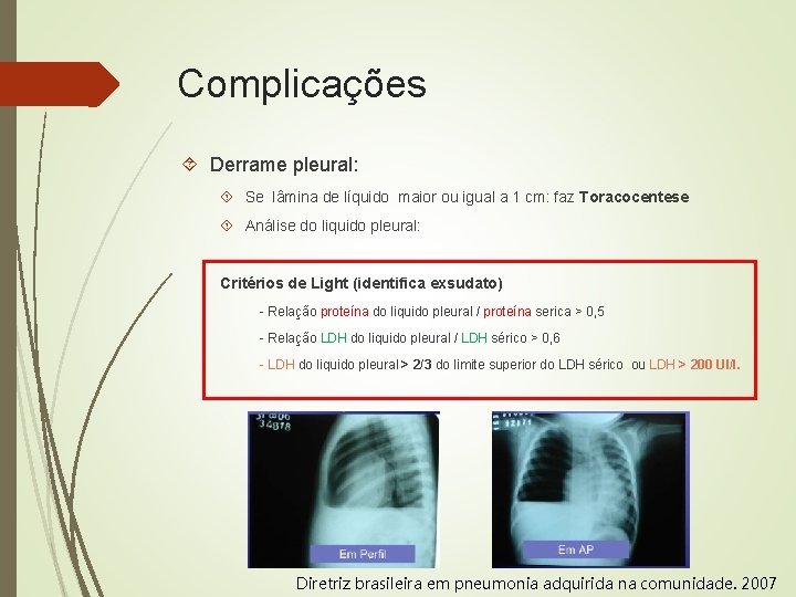 Complicações Derrame pleural: Se lâmina de líquido maior ou igual a 1 cm: faz